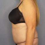 High BMI (Larger Patients) Surgery Before & After Patient #10356