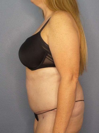Abdominoplasty Before & After Patient #3366