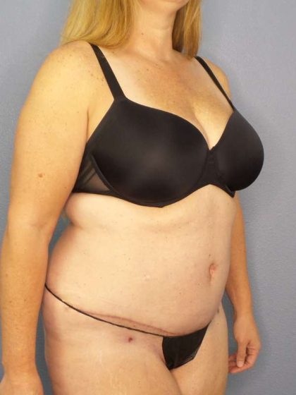 Abdominoplasty Before & After Patient #3366