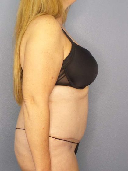 Abdominoplasty Before & After Patient #3366