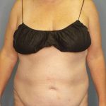 Abdominoplasty Before & After Patient #3366