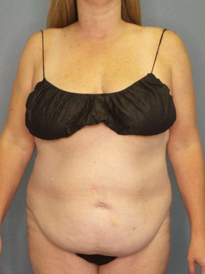 Abdominoplasty Before & After Patient #3366