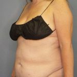 Abdominoplasty Before & After Patient #3366