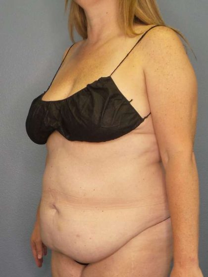 Abdominoplasty Before & After Patient #3366