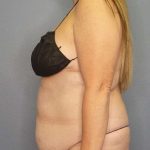 Abdominoplasty Before & After Patient #3366