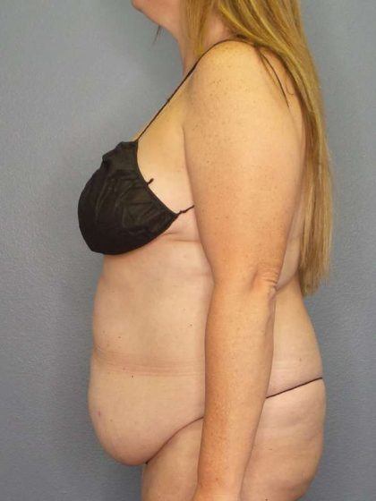Abdominoplasty Before & After Patient #3366
