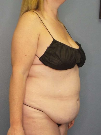 High BMI (Larger Patients) Surgery Before & After Patient #10356