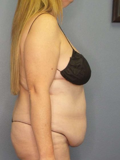 Abdominoplasty Before & After Patient #3366