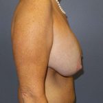 Breast Lift with Implant (Augmentation Mastopexy) Before & After Patient #4383