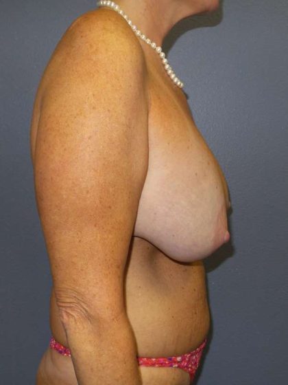 Breast Lift with Implant (Augmentation Mastopexy) Before & After Patient #4383