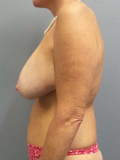 Breast Lift with Implant (Augmentation Mastopexy) Before & After Patient #4383