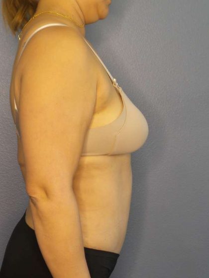 Abdominoplasty Before & After Patient #3261