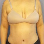 Abdominoplasty Before & After Patient #3261