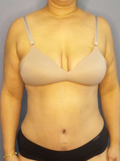 Abdominoplasty Before & After Patient #3261