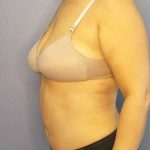 Abdominoplasty Before & After Patient #3261