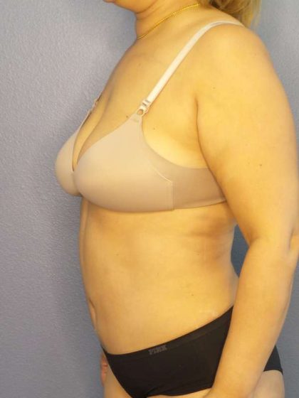 Abdominoplasty Before & After Patient #3261