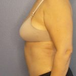Abdominoplasty Before & After Patient #3261