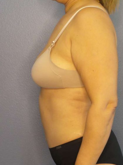 Abdominoplasty Before & After Patient #3261