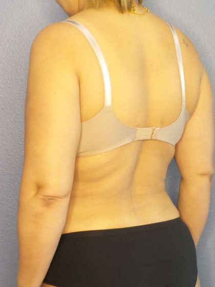 Abdominoplasty Before & After Patient #3261