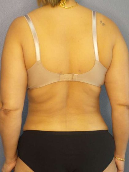 Abdominoplasty Before & After Patient #3261