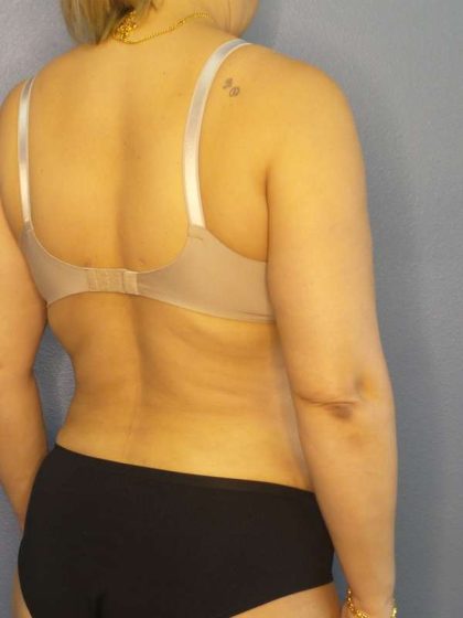 Abdominoplasty Before & After Patient #3261