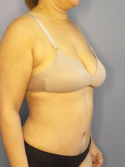 Abdominoplasty Before & After Patient #3261
