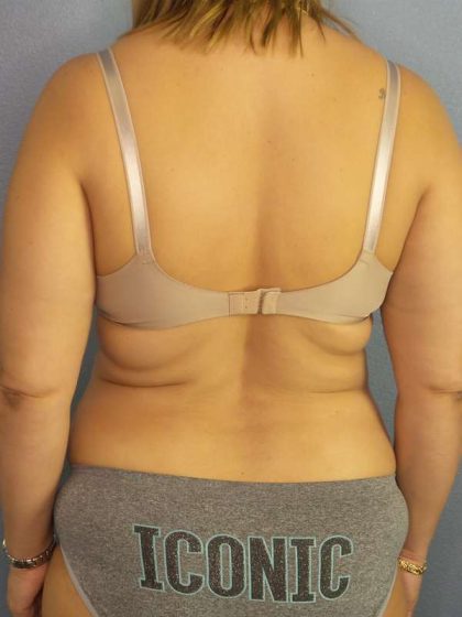 Abdominoplasty Before & After Patient #3261