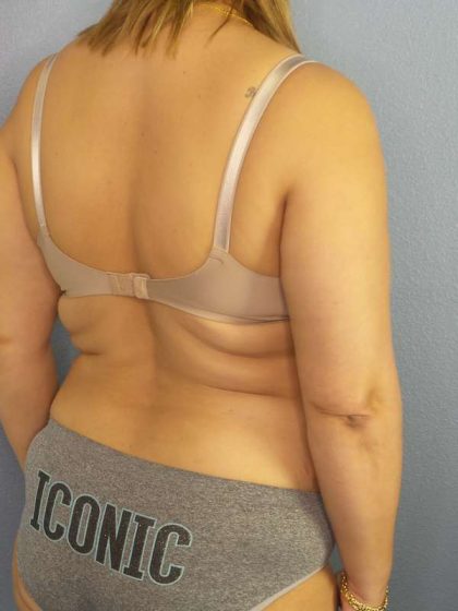 Abdominoplasty Before & After Patient #3261