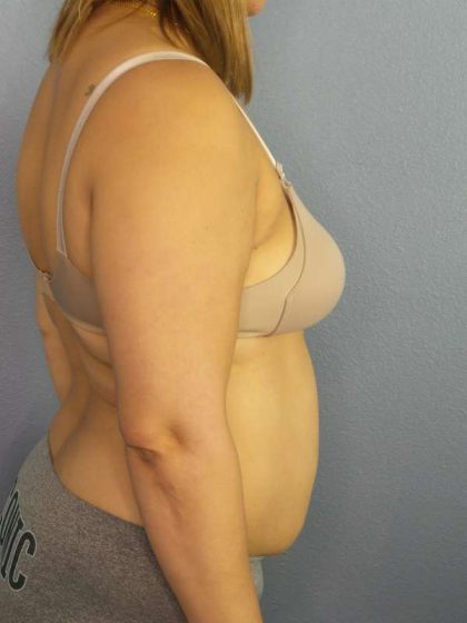 Abdominoplasty Before & After Patient #3261