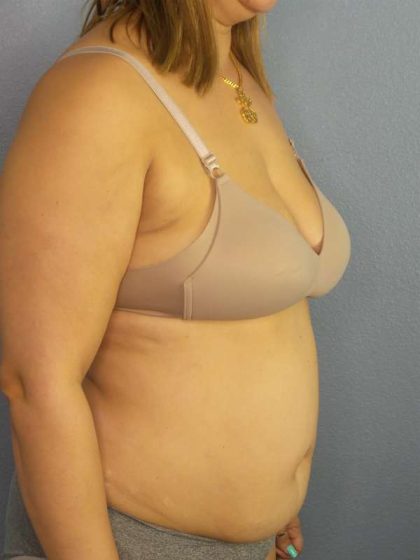 Abdominoplasty Before & After Patient #3261