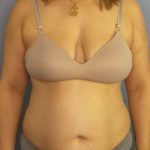 Abdominoplasty Before & After Patient #3261
