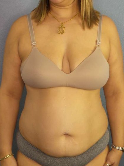 Abdominoplasty Before & After Patient #3261