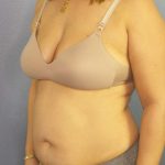 Abdominoplasty Before & After Patient #3261