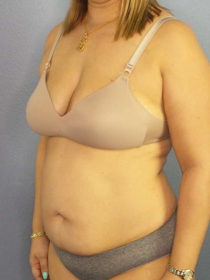Abdominoplasty Before & After Patient #3261