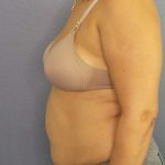 Abdominoplasty Before & After Patient #3261