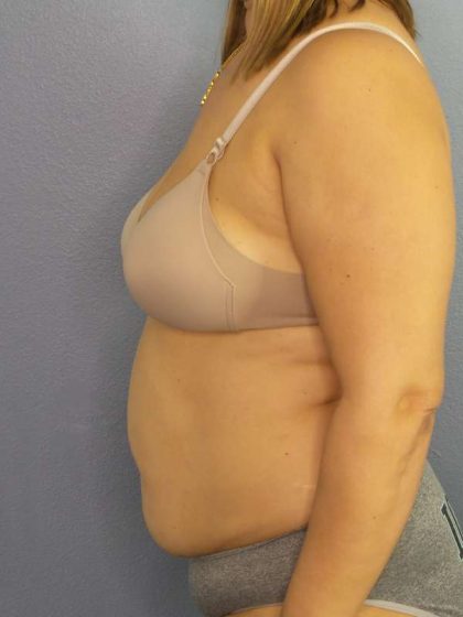 Abdominoplasty Before & After Patient #3261