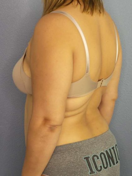 Abdominoplasty Before & After Patient #3261