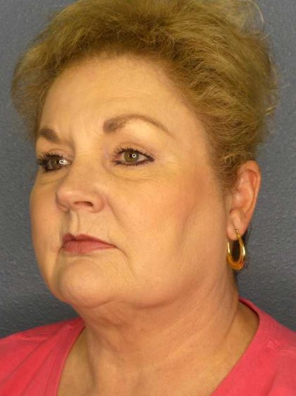 Liposuction of the Neck Before & After Patient #12031