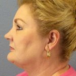 Liposuction of the Neck Before & After Patient #12031