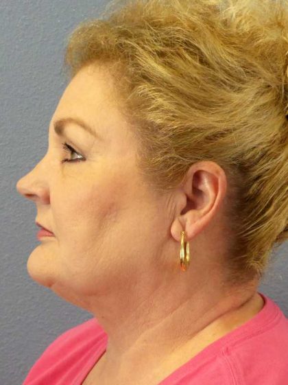 Liposuction of the Neck Before & After Patient #12031