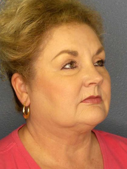 Liposuction of the Neck Before & After Patient #12031
