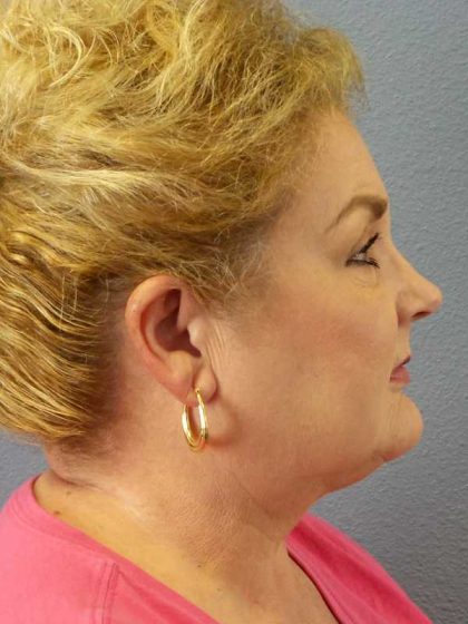 Liposuction of the Neck Before & After Patient #12031