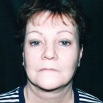 Facelift Before & After Patient #7512