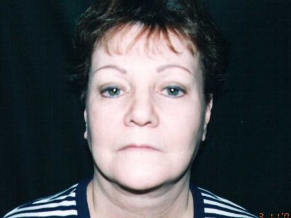 Facelift Before & After Patient #7512