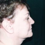 Facelift Before & After Patient #7512