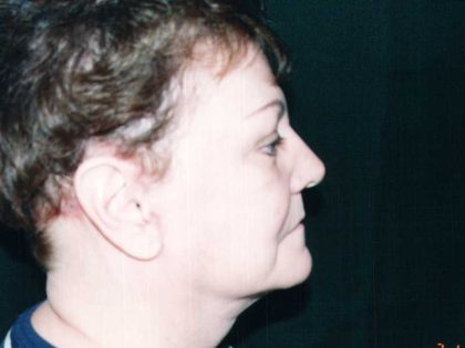 Facelift Before & After Patient #7512