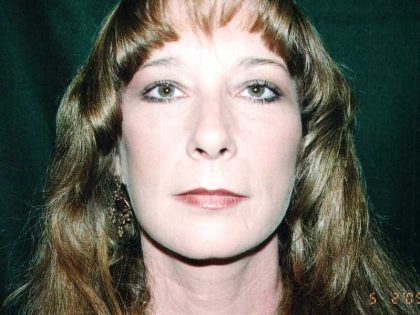 Facelift Before & After Patient #7574