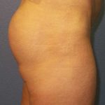 Brazilian Butt Lift Before & After Patient #11294