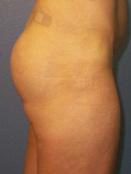 Brazilian Butt Lift Before & After Patient #11294