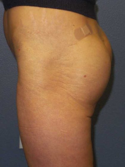 Brazilian Butt Lift Before & After Patient #11294